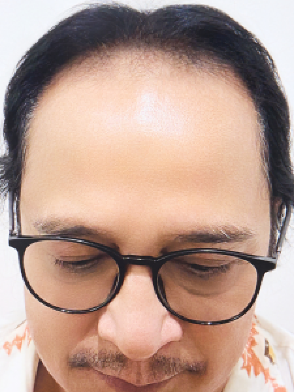 Sebelum - Hair Transplant