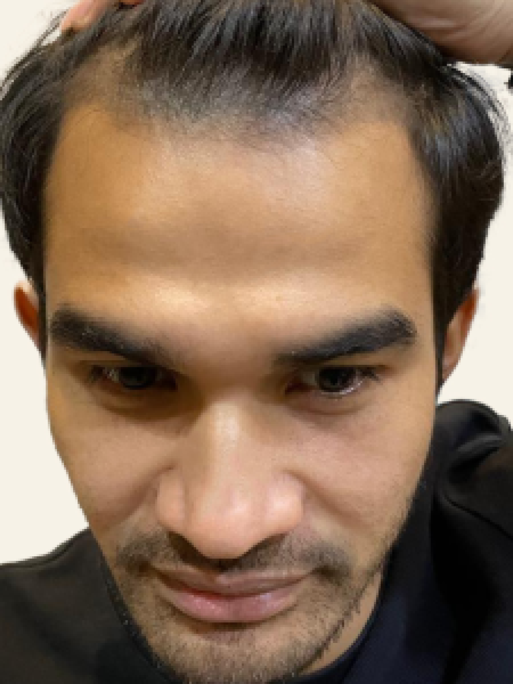 Sebelum - Hair Transplant