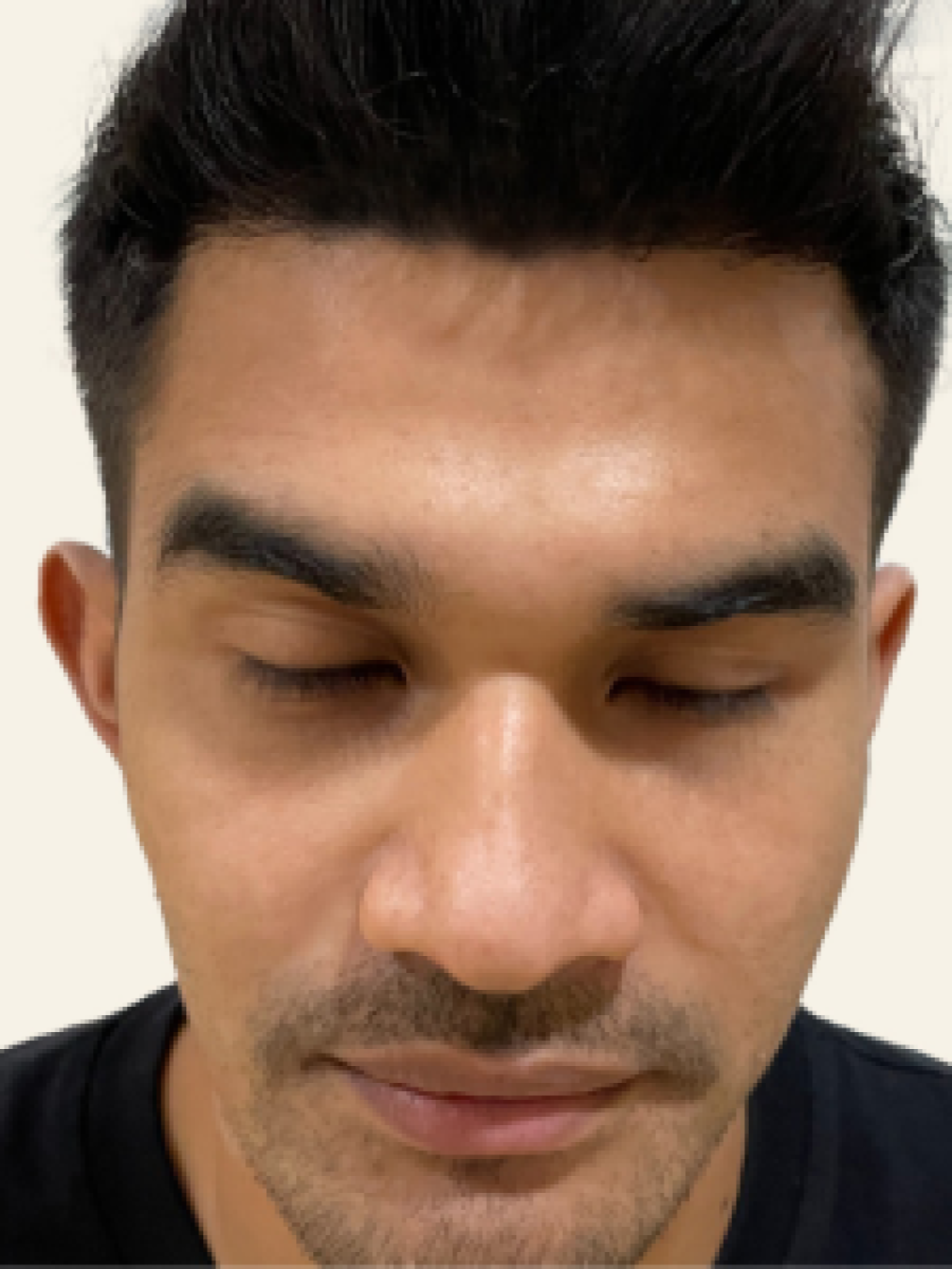 Sesudah - Hair Transplant