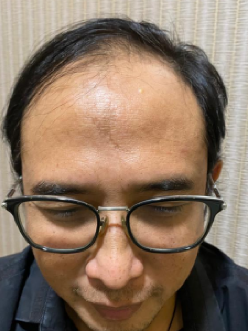 Sebelum - Hair Transplant