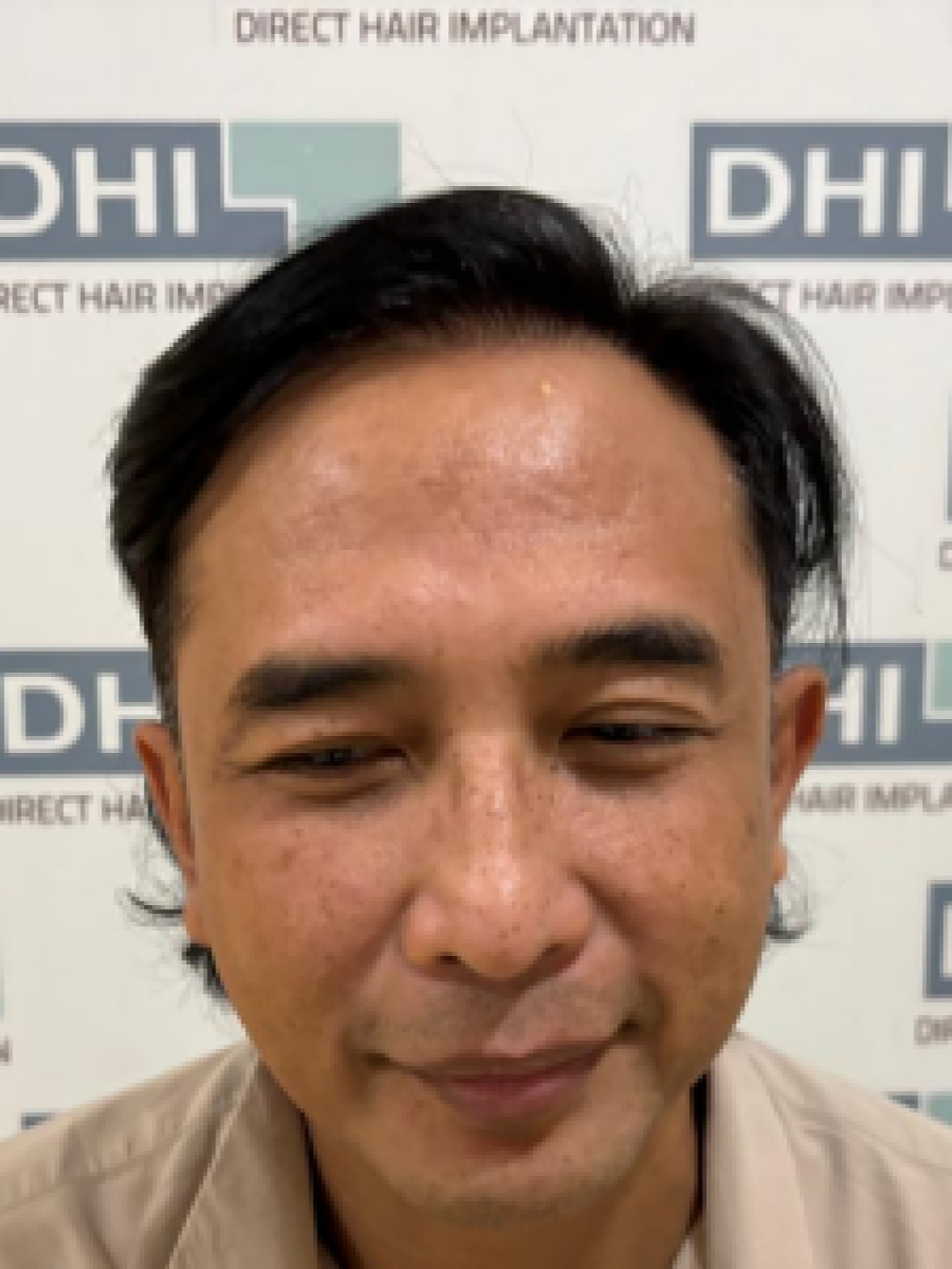 Sesudah - Hair Transplant