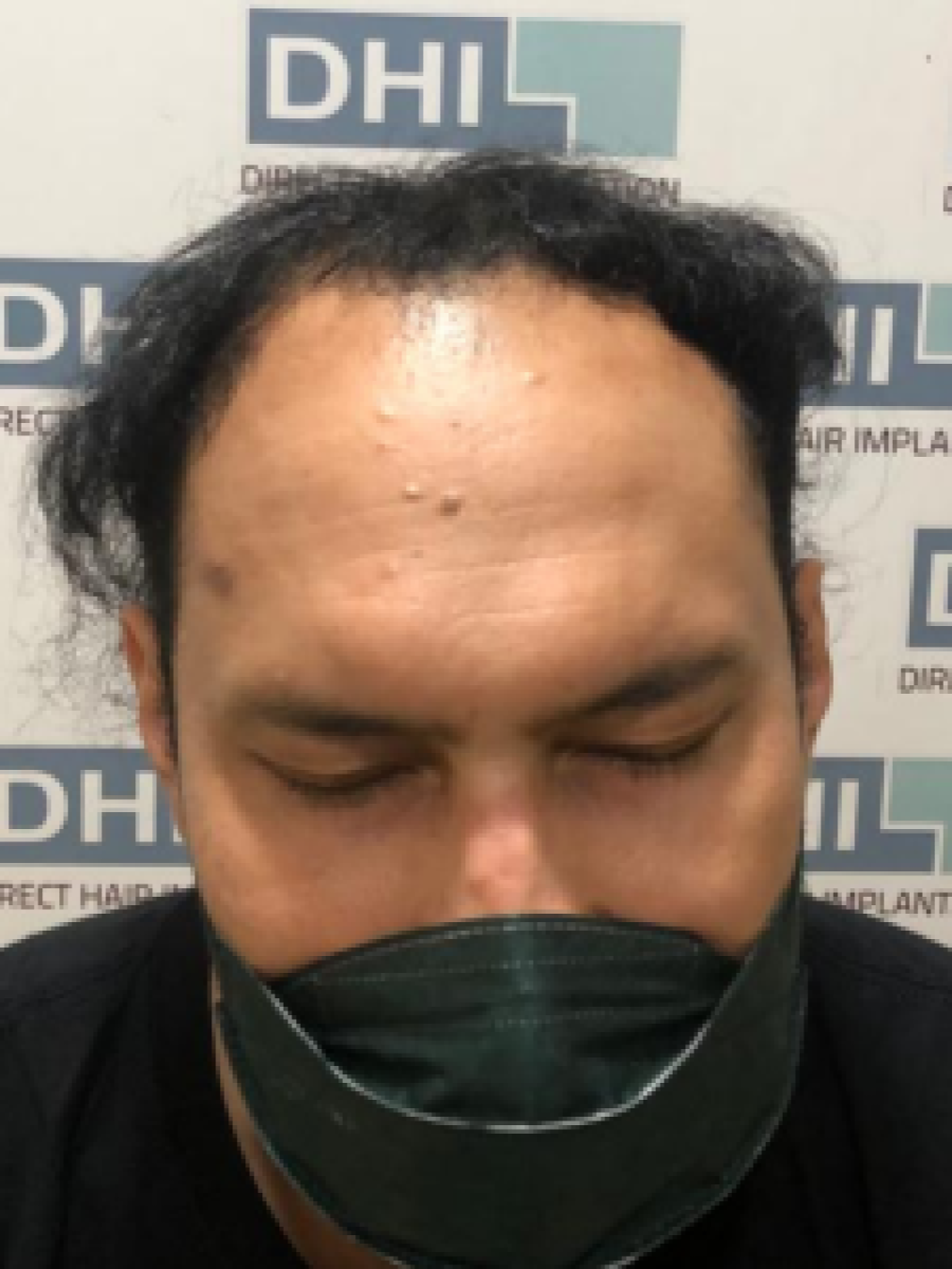 Sebelum - Hair Transplant