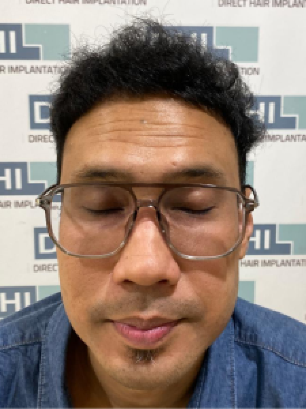 Sesudah - Hair Transplant