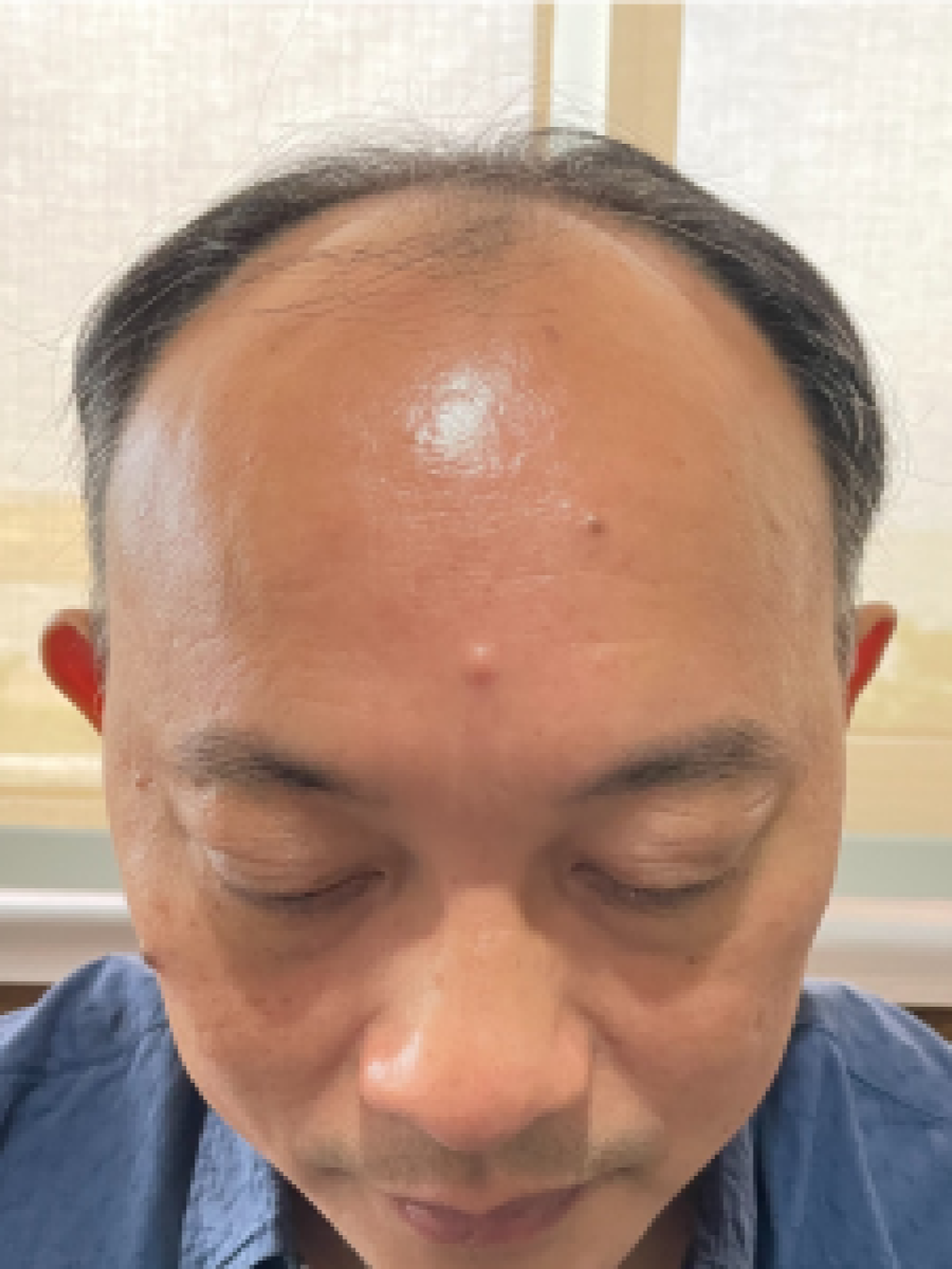 Sebelum - Hair Transplant