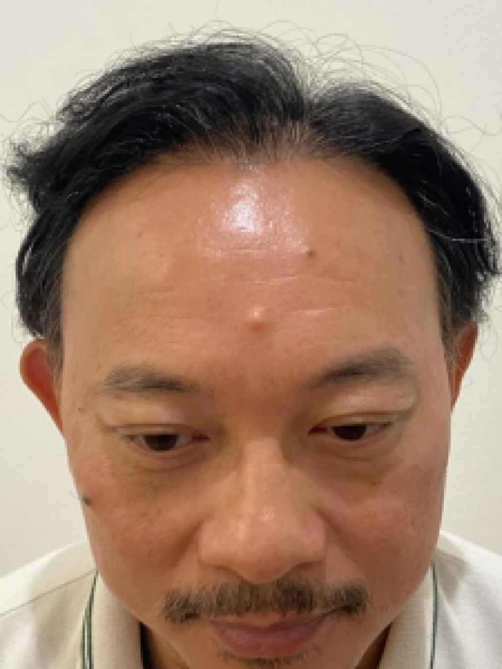Sesudah - Hair Transplant