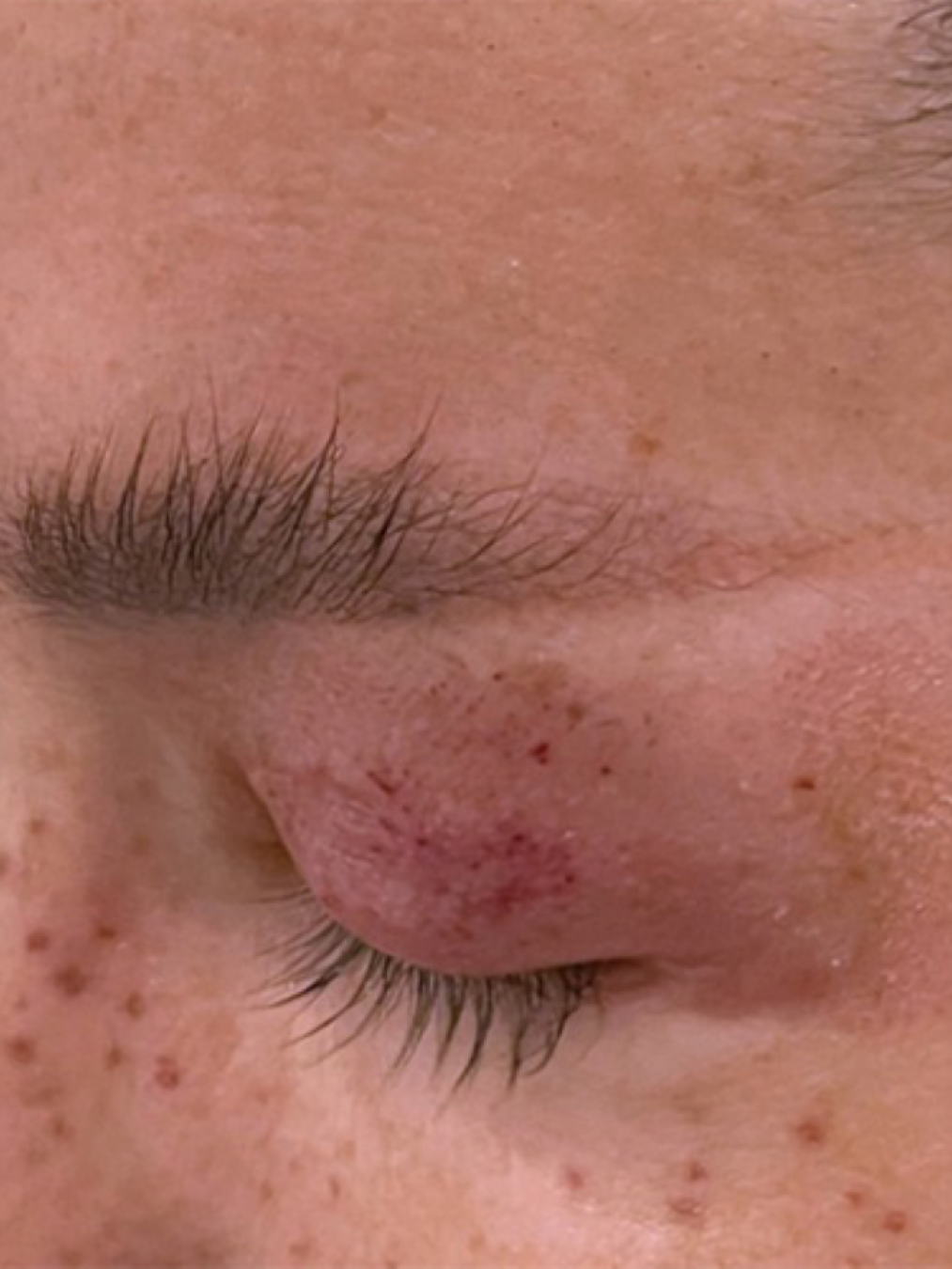 Sebelum - Eyebrow Transplant