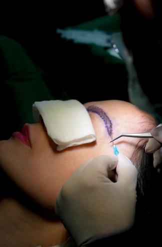 Eyebrow Restoration