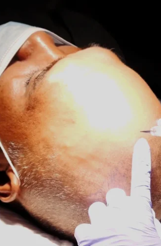Scalp Micropigmentation (Mpg)